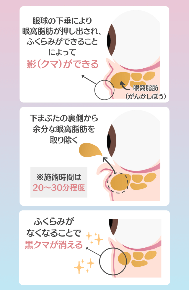 脱脂法（切らないクマ取り）