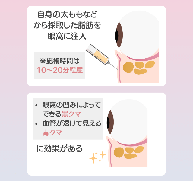 脂肪注入