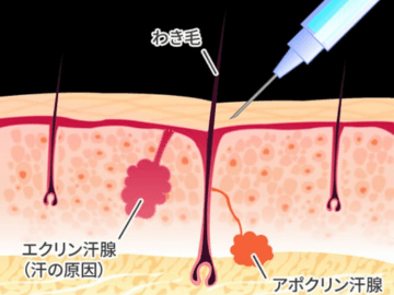 ボトックス注射