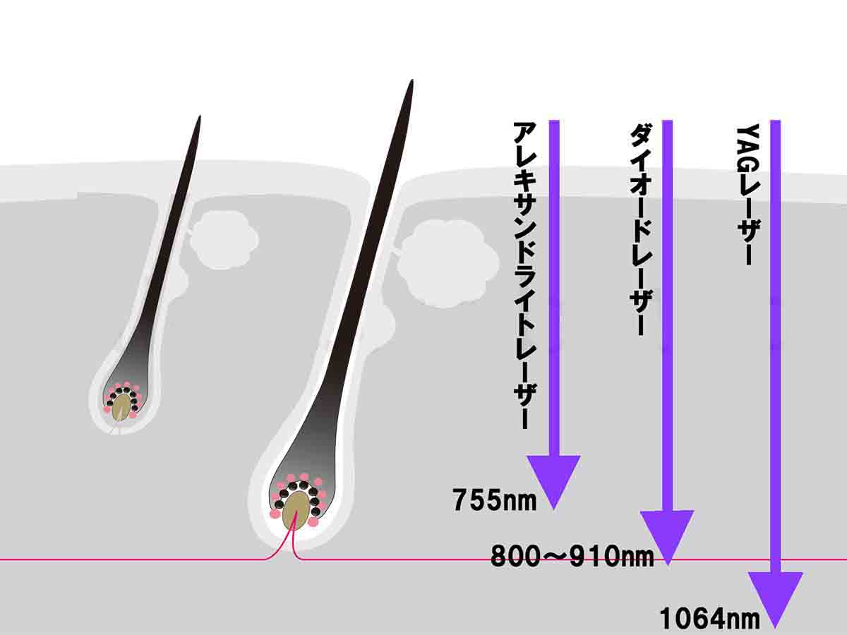 レーザーの種類