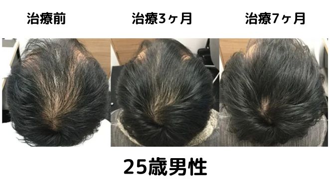 AGAヘアクリニックを実際に利用した方の症例写真2