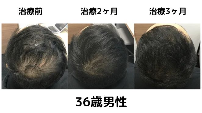 AGAヘアクリニックを実際に利用した方の症例写真