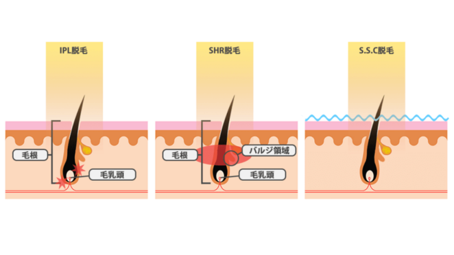 サロン脱毛の脱毛方式