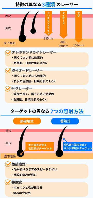 医療脱毛の照射方法とレーザーの種類の図解