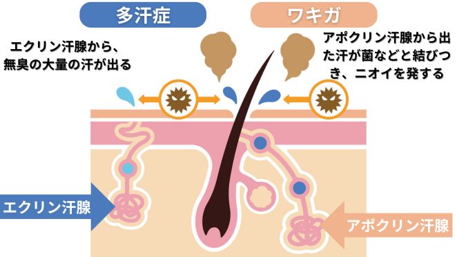 多汗症とワキガの違いの図解